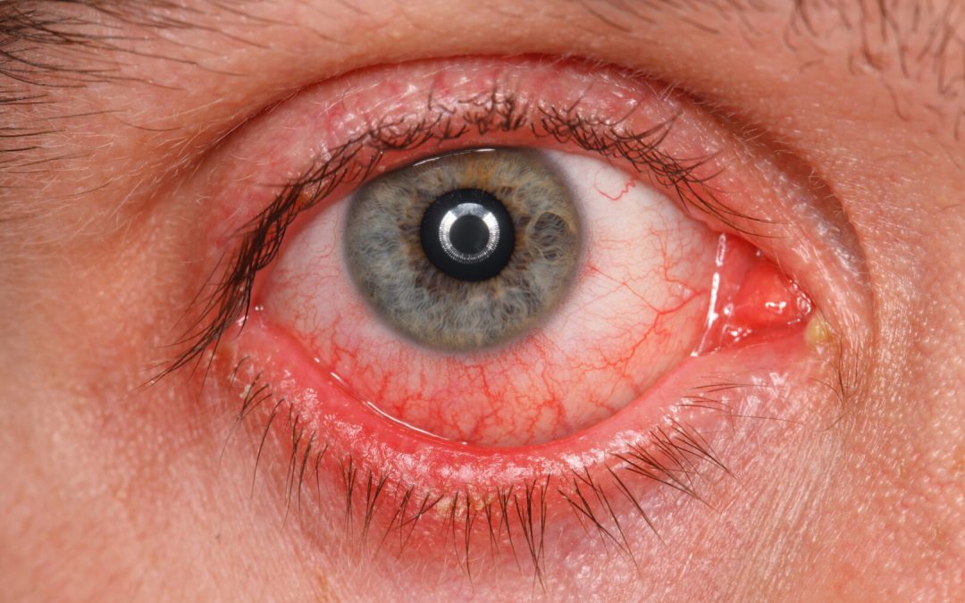 Enfermedades más comunes de los ojos