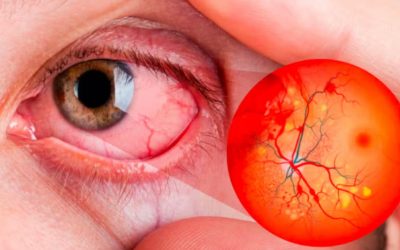 Cinco enfermedades visuales por el descontrol de la diabetes
